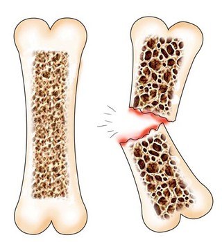 osteo