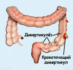 divertikulez-sigmovidnoj-kishki