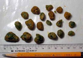 liver-kamni1