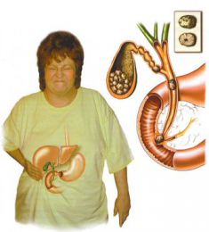 dieu-tri-polyp-tui-mat