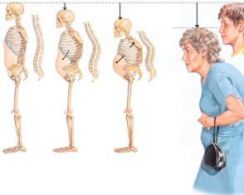 osteoporoz2